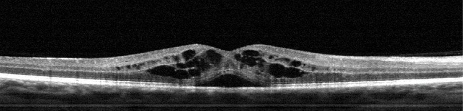 unhealthy retina